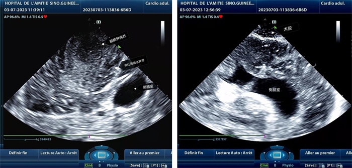 左圖顯示術(shù)中超聲見囊實(shí)性病變，大小約為4x4x3cm，病灶周圍腦組織水腫明顯；右圖為病灶切除后，術(shù)中超聲示術(shù)腔無病變殘留
