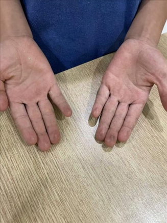 9歲小學(xué)生長(zhǎng)期拍煙卡，手部粗糙長(zhǎng)繭。受訪者供圖